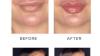Best Lip fillers in Abu Dhabi | Skin Institute Dermatology Centre