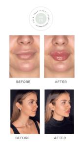 Best Lip fillers in Abu Dhabi | Skin Institute Dermatology Centre
