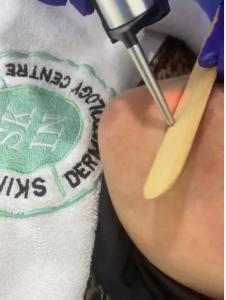 Permanent Hair Removal | Laser Hair Removal in Abu Dhabi