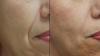 Best Face Lifting Treatment In Abu Dhabi | Skin Clinic