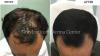 Best PRP Hair Treatment In Abu Dhabi | Skin Clinic