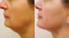 Best Face Lifting Treatment In Abu Dhabi | Skin Clinic