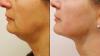 Face lifting treatment near me | Skin Institute Clinic Abu Dhabi